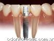 Implantes odontológicos estética dental