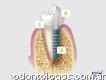 Odontología Integral - Implantes